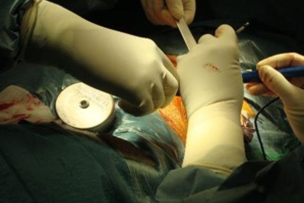 Primeros implantes de neuroestimuladores peridurales y bombas de perfusión continua intratecal para el tratamiento de la espasticidad.