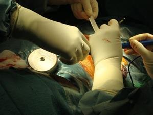 Primeros implantes de neuroestimuladores peridurales y bombas de perfusión continua intratecal para el tratamiento de la espasticidad.